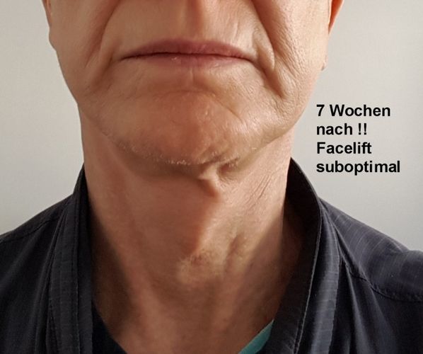 Frustriert Nach Face Halslift Mit Lidplastik Vor Wochen Estheticon De