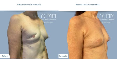 Reconstrucción mamaria - Clínica FEMM