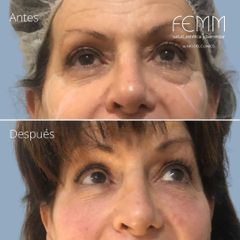 Blefaroplastia sin cirugía - Clínica FEMM
