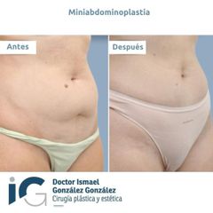 Mini abdominoplastia - Clínica FEMM