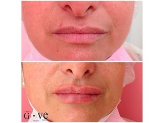 Aumento de labios -  Clínica Gove