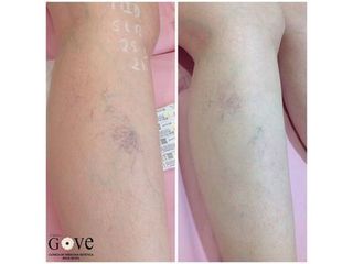 Laser vascular - Clínica Gove