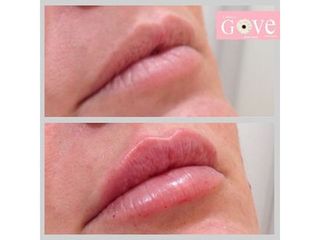 Aumento de labios - Clínica Gove