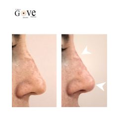 Rinomodelación  - Clínica Gove