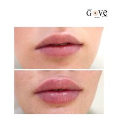 Aumento de labios - Clínica Gove