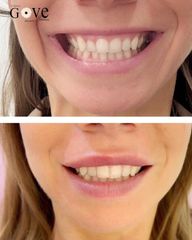 Sonrisa gingival - Clínica Gove