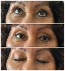 Blefaroplastia - Dr. Carlos Miera