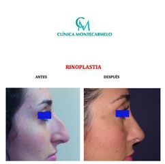 Antes y después Rinoplastia - Clínica Montecarmelo