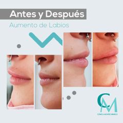 Antes y después Aumento de labios - Clínica Montecarmelo