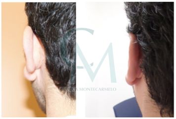 otoplastia -  Clínica Montecarmelo