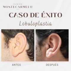Lobuloplastia  - Clínica Montecarmelo