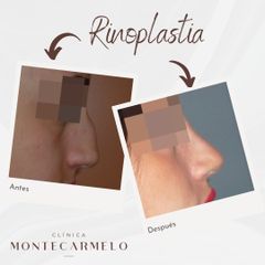 Rinoplastia - Clínica Montecarmelo
