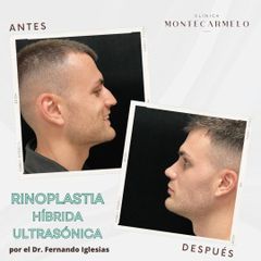 Rinoplastia - Clínica Montecarmelo