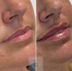 Aumento de labios - Dra. Lara Bañúls Laguía