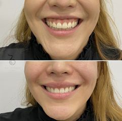 Sonrisa gingival - Dra. Lara Bañúls