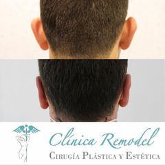 Otoplastia - Dra. Estefanía Poza Guedes