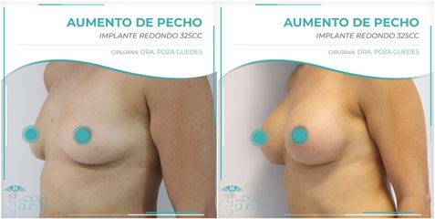 Aumento de pecho - Dra. Estefanía Poza Guedes
