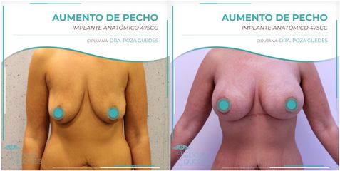 Aumento de pecho - Dra. Estefanía Poza Guedes