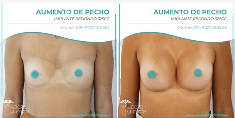 Aumento de pecho - Dra. Estefanía Poza Guedes