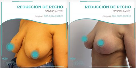 Reducción de senos - Dra. Estefanía Poza Guedes