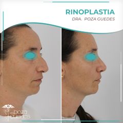 Rinoplastia - Dra. Estefanía Poza Guedes