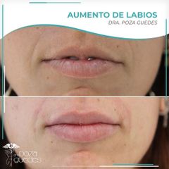 Aumento de labios - Dra. Estefanía Poza Guedes