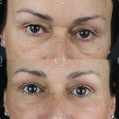 Antes y después Párpados caídos. Blefaroplastia láser co2