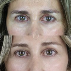 Antes y después Elevación de cejas con ácido hialurónico
