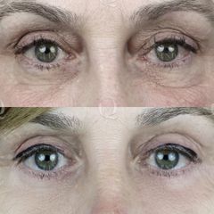 Antes y después Blefaroplastia mediante resurfacing CO2 periocular y Accutite