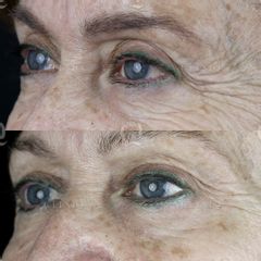 Antes y después Elevación cejas sin cirugía mediante microinyecciones de ácido hialurónico.
