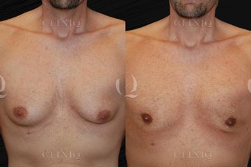 Antes y después Lipovaser en paciente masculino con ginecomastia. Reducción sin cicatrices visibles.