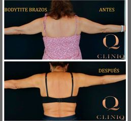 Antes y después Liposucción 