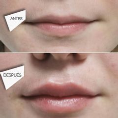 Aumento de labios - Imebelle