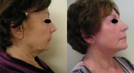facelifting9