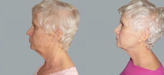 Facelift - OB Care
