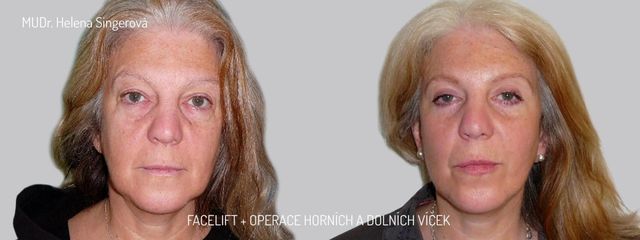 BEFORE Facelift + víčka 1