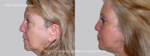 BEFORE Facelift + víčka 2