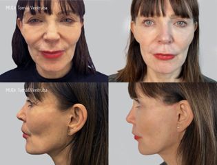 Facelift  - Asklepion