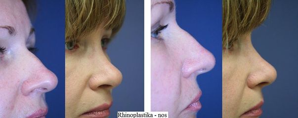 rhinoplastika nos