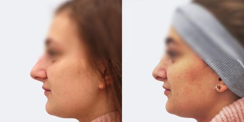 Rhinoplastika - MUDr. Peter Ondrejka - MEDICOM Clinic