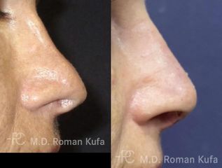 Sekundární rhinoplastika