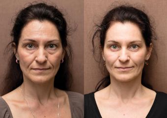 ANTIAGING PRED PO 004