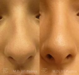 Rhinoplastika