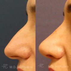 Rhinoplastika