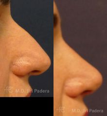 Rhinoplastika