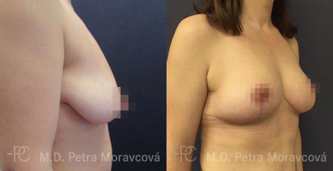 modelace prsu PM Pred II