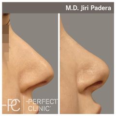 Rhinoplastika - Dr. Paděra - Perfect Clinic
