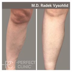 Odstranění křečových žil - Perfect Clinic