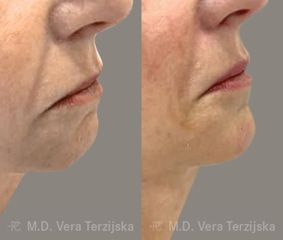 Injekční výplně - Perfect Clinic - centrum estetické medicíny