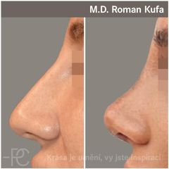 Rhinoplastika - Perfect Clinic - centrum estetické medicíny